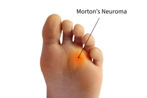 Understanding and Relieving Morton&#039;s Neuroma