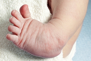 Clubfoot and Other Foot Abnormalities in Babies